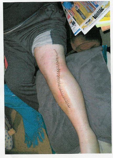 scar.jpg